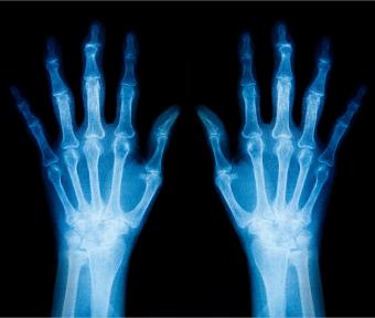 radiografía de manos