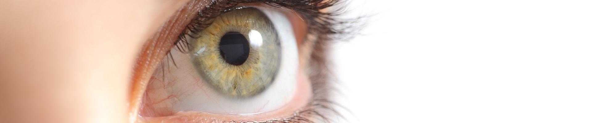 Conjuntivitis: cómo tratarla y qué hacer para no contagiarla